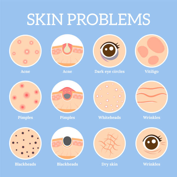 Skin problems. Ages wrinkles problem, face skin infection treatment and dark circles under eyes vector icons set Skin problems. Ages wrinkles problem, face skin infection treatment and dark circles under eyes or black head pores, acne problems. Dermatology health vector icons set acne cartoon stock illustrations