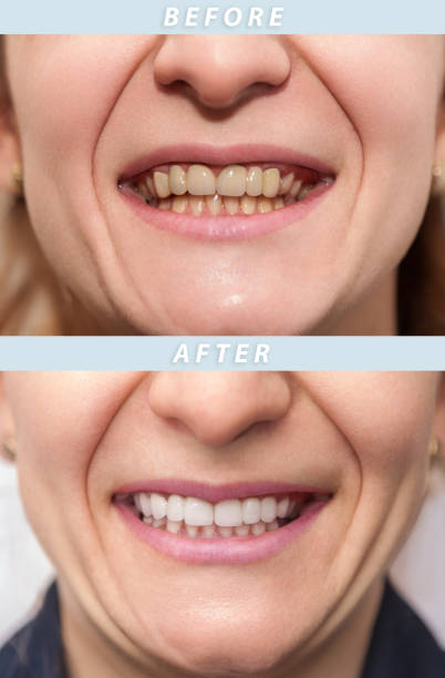 istock Woman teeth before and after dental treatment 1066637936