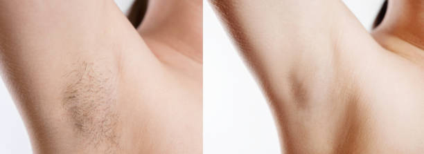 mujer con pelo de axila, mujeres axilas peludas, axila de mujer limpia, antes y después del afeitado - waxing armpit women beauty treatment fotografías e imágenes de stock