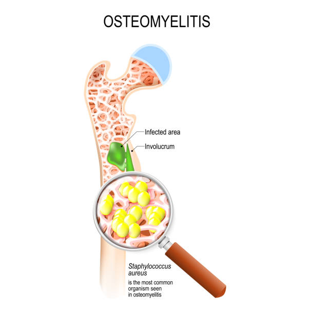 Osteomyelitis is infection in the bone. Close-up bacteria (Staphylococcus aureus) that caused this disease. Vector diagram shows Osteomyelitis is infection in the bone. Close-up bacteria (Staphylococcus aureus) that caused this disease. Vector diagram shows osteomyelitis of a humans tubular bone, and pathogens. Illustration for medical use aureus stock illustrations