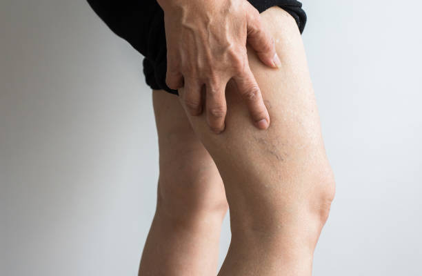 spataderen op de benen van de bejaarde dames, close up - woman legs veins stockfoto's en -beelden