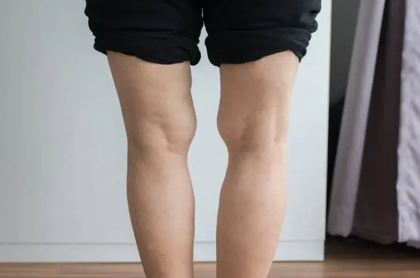 Asian elderly woman leg bandy-legged shape of the body