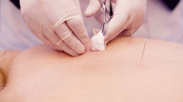 istock Chinese therapist putting needles to the patient 1067324938