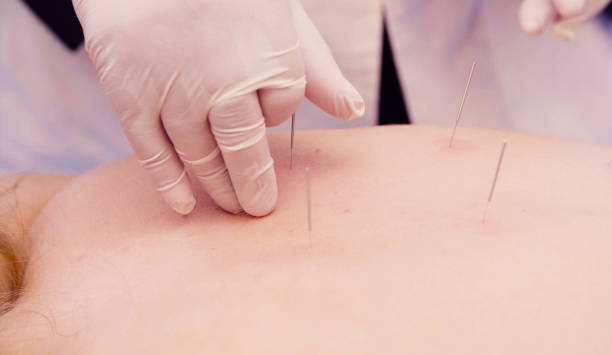 istock Chinese therapist putting needles to the patient 1067324956