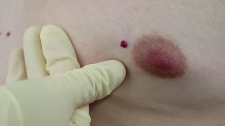 Angioma. Red birthmark on the skin surface.