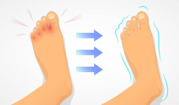 ilustrações de stock, clip art, desenhos animados e ícones de a foot affected by a fungus and a healthy foot - human foot pain white background isolated
