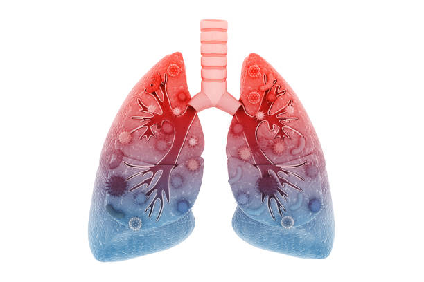 istock Virus and bacteria infected the Human lungs. lung disease 1068343454