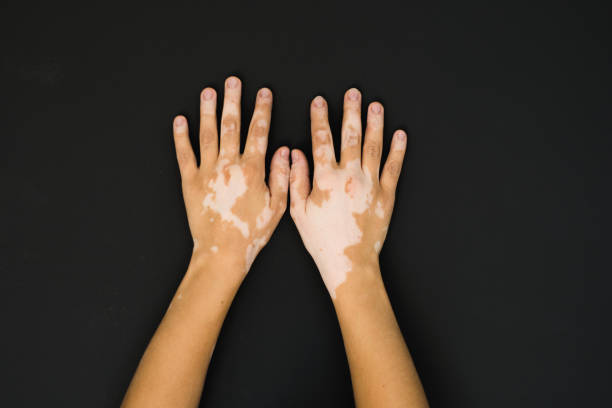 vitiligo - depigmentáció témájú stock jellegű vizuális alkotások, jogdíjmentes fotók és képek