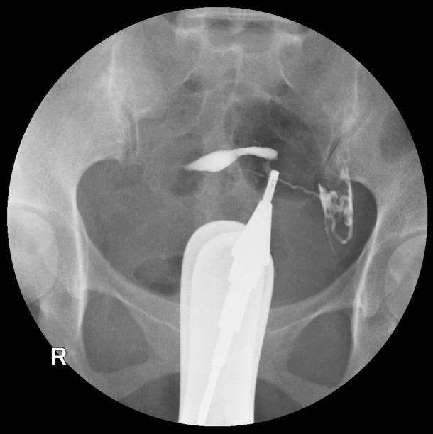 istock Hysterosalpingography (HSG) is a fluoroscopic X-ray study of a woman's uterus and fallopian tubes. 1068685532
