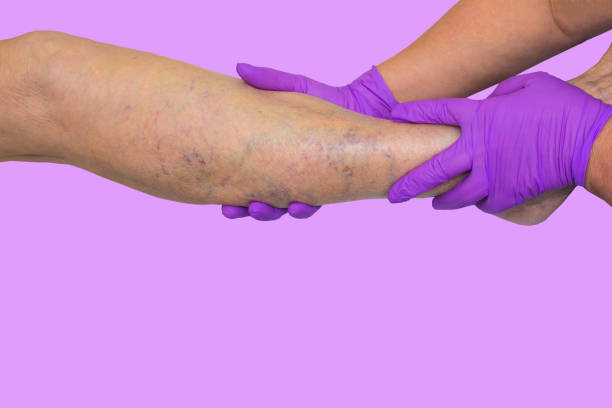 Lower limb vascular examination because suspect of venous insufficiency. Lower limb vascular examination because suspect of venous insufficiency. The female legs on pink background spider veins stock pictures, royalty-free photos & images