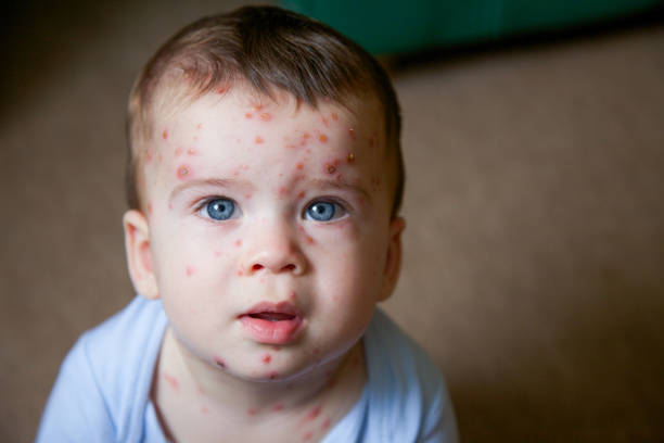 Young toddler with chickenpox stock photo