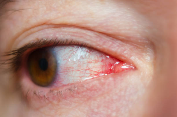 istock Closeup irritated infected red bloodshot eyes, conjunctivitis 1068852296