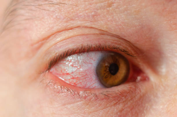 istock Closeup irritated infected red bloodshot eyes, conjunctivitis 1068852298