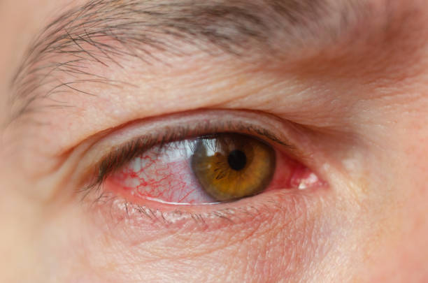 istock Closeup irritated infected red bloodshot eyes, conjunctivitis 1068852300