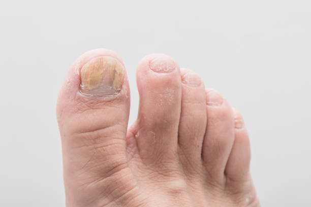 foot of nail fungus Close-up foot of nail fungus toenail stock pictures, royalty-free photos & images