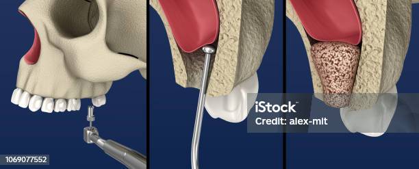 Sinus Lift Surgery Sinus Augmentation 3d Illustration Stock Photo -  Download Image Now - iStock