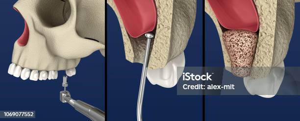 Sinus Lift Surgery Sinus Augmentation 3d Illustration Stock Photo - Download Image Now - iStock Sinus Lift Surgery Sinus Augmentation 3d Illustration Stock Photo - Download Image Now - iStock