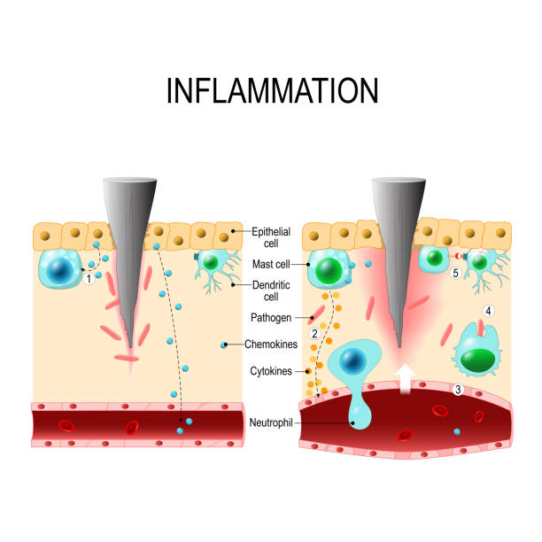 Inflammation Immune System Vector Diagram For Educational Biological Medical  And Science Use Stock Illustration - Download Image Now - iStock