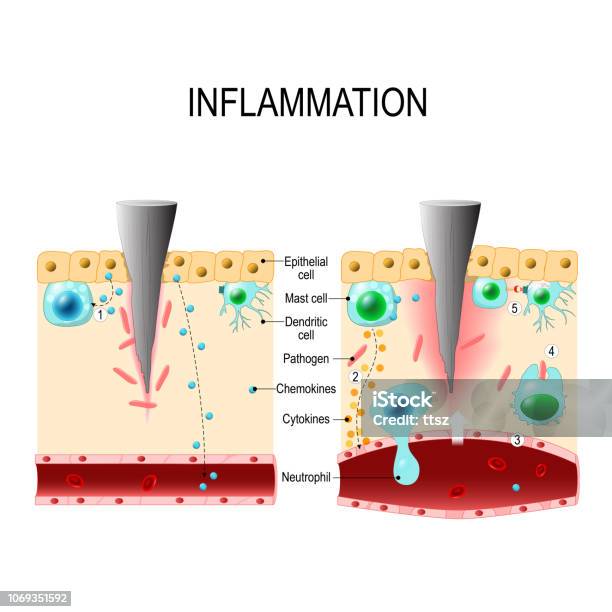 Inflammatory Process Infographic Inflammation Immune System Vector Diagram For Educational Biological ...