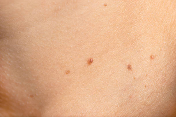 istock Papillomas or mole on female neck close up background 1069636102