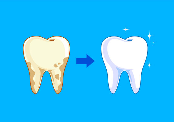 Tooth before and after. Yellow becomes white, Dental care concept,  illustration isolated on blue background. bad teeth stock illustrations