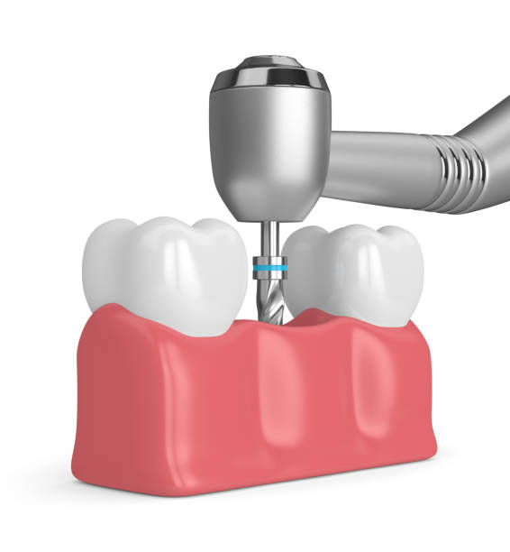 istock 3d render of teeth with dental drill 1070552352