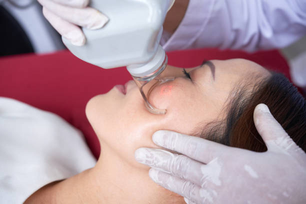 soin du visage au laser - peeling beauty treatment human face beautician photos et images de collection