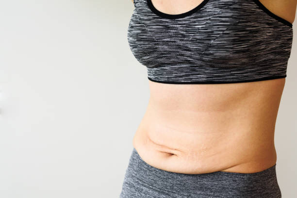 istock Woman belly after dieting 1070960944