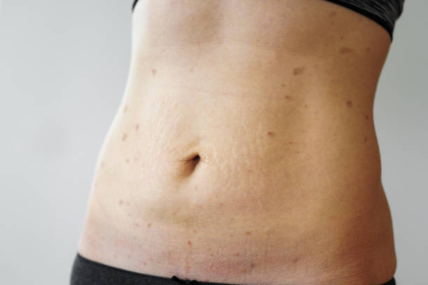 istock Woman belly with lichen planus 1070967964