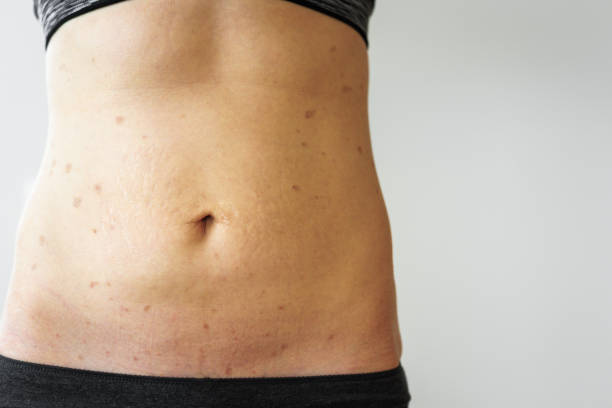 istock Woman belly with lichen planus 1070968810