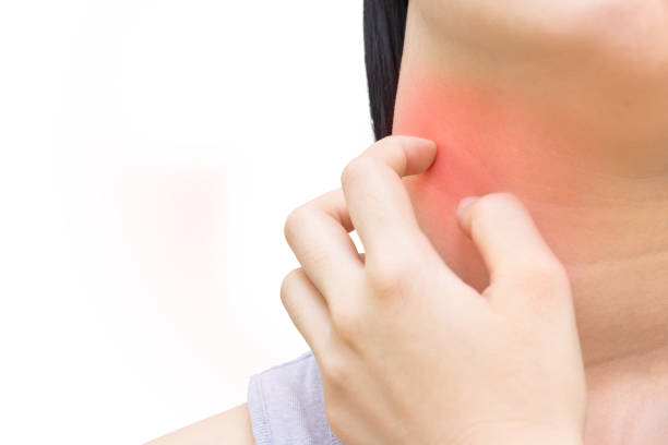 istock Woman has skin rash itch on neck 1071070944