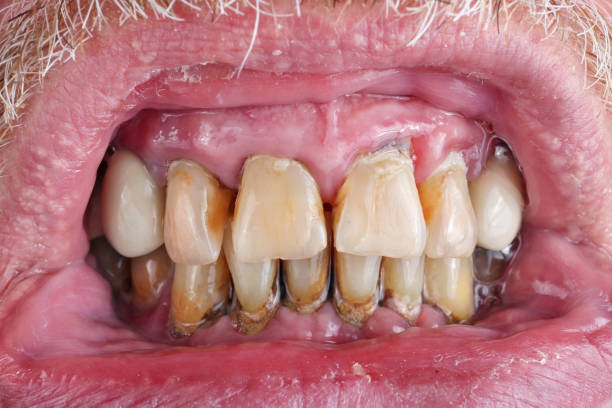 The teeth of an elderly man are spoiled by caries, tartar and poor nutrition  macro. The teeth of an elderly man are spoiled by caries, tartar and poor nutrition  macro. The harm of alcohol and tobacco concept. Studio macro shot bad teeth stock pictures, royalty-free photos & images