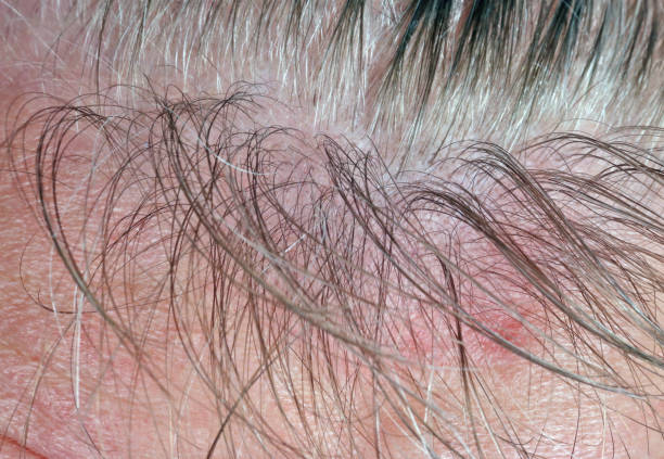 Sore greasy skin and sparse gray hair on the head of a balding elderly man. stock photo