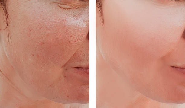istock woman wrinkles face before and after procedures 1071502926