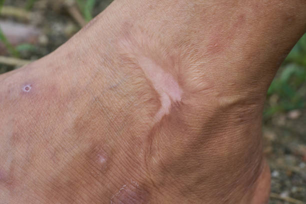 istock Scar at the ankle 1071686166