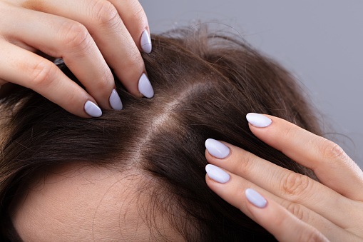 Close-up Of Woman With Thinning Hair On Head