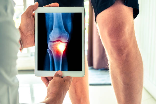 médico sosteniendo una tableta digital con radiografía de rodilla del paciente - arrodillarse fotografías e imágenes de stock