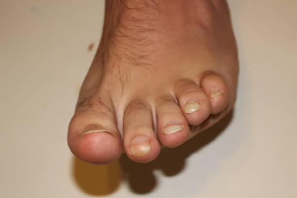 mans foot, gross stock photo