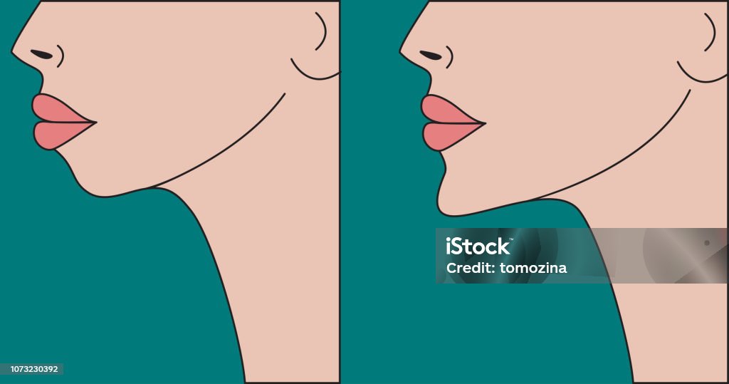 Cosmetic correction small weak chin Cosmetic correction small weak chin, plastic surgery chin, reduction surgery, chin implants. Vector illustration before and after Human Jaw Bone stock vector