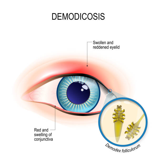 istock demodicosis of eyelid and red eyes. Close-up demodex through magnifying glass. 1073232990