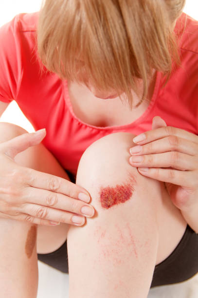 istock a woman examines a wound on her knee 1073276306