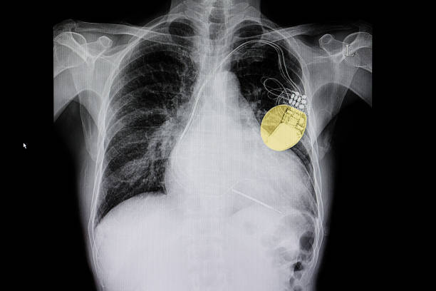ein herzschrittmacher - human heart heart attack x ray image chest stock-fotos und bilder
