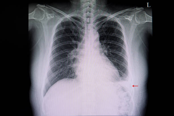 istock cardiomegaly and pneumonia 1073505426
