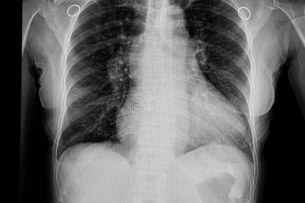 istock cardiomegaly and congestive heart failure 1073506426