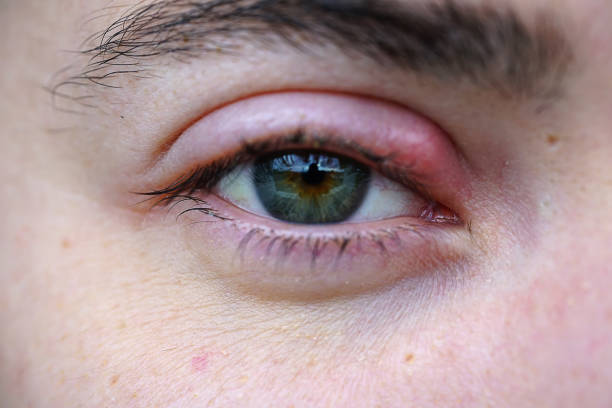 Eye stye macro stock photo