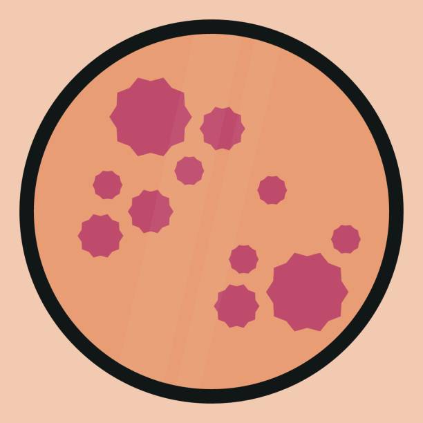 Measles virus Measles virus vector illustration. Highly contagious infectious disease on the skin and body. measles illustrations stock illustrations