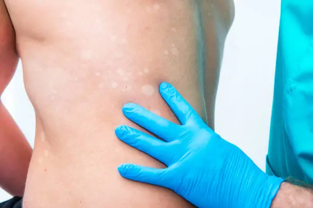 Photo of Close up doctor dermatologist hands in gloves examines skin depigmentation on mans back. Selective focus. copy space.