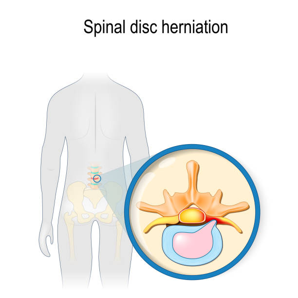 przepukliny dysku kręgowego. ból pleców. - human spine human vertebra disk spinal stock illustrations