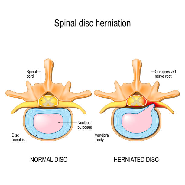 ilustrações, clipart, desenhos animados e ícones de disco normal e hérnia de disco nas vértebras cervicais. - human spine human vertebra disk spinal