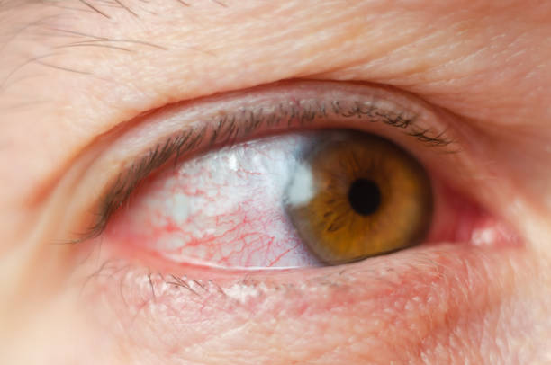 istock Closeup irritated infected red bloodshot eyes, conjunctivitis 1074468262
